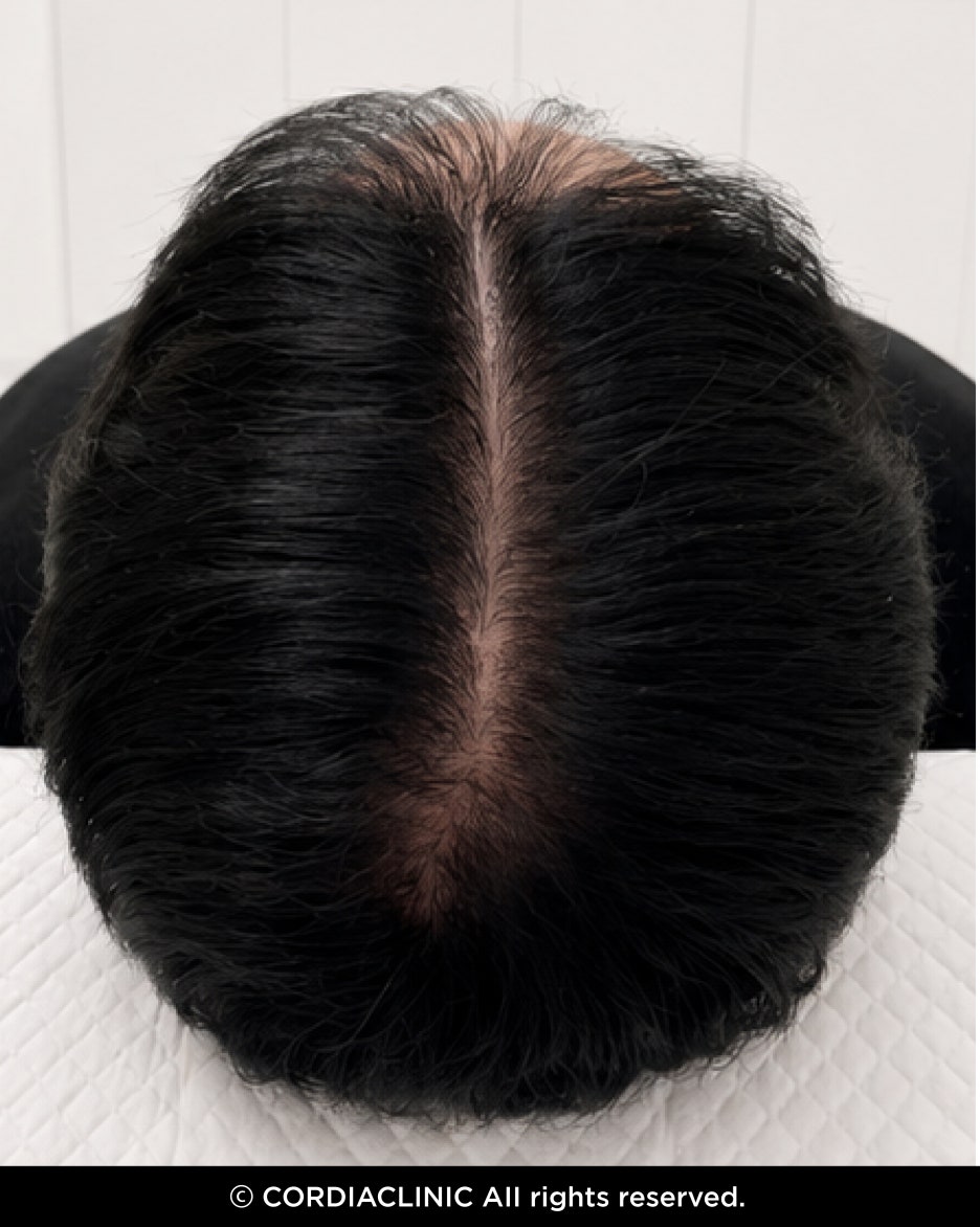 도곡역 피부과에서 가장 많이 받는 질문, 모낭주사 꼭 맞아야 하나요? 사진 7