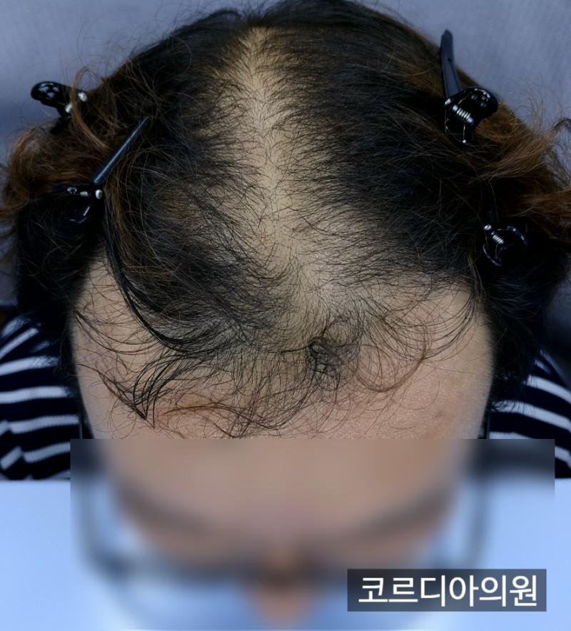 머리카락이 가늘어지는 것도 탈모일까요? 모발 미니어처화란 | 선릉 탈모치료 병원