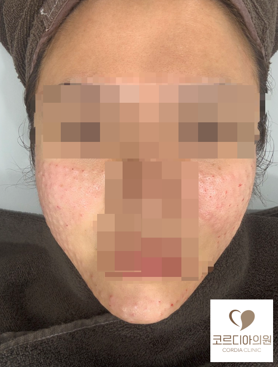 스킨부스터 엠보가 생기는 이유: 깊이와 주입량의 관계