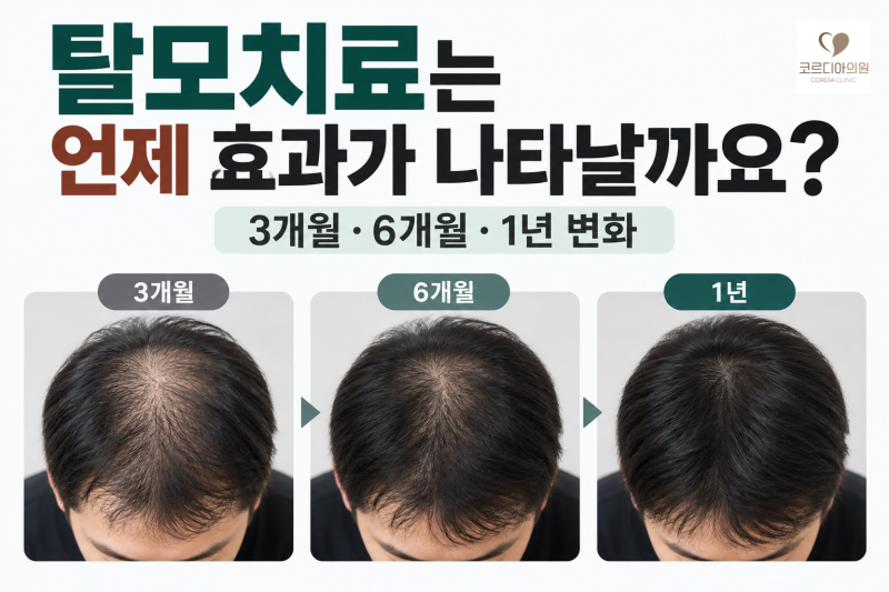 탈모치료는 언제 효과가 나타날까요? 3개월·6개월·1년 변화 | 선릉역 탈모치료 병원