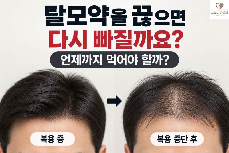 탈모약을 끊으면 다시 빠질까요? 언제까지 먹어야 할까 | 선릉 탈모치료 병원