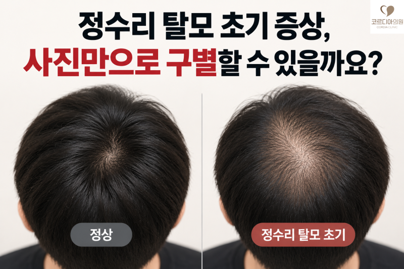 정수리 탈모 초기 증상, 사진만으로 구별할 수 있을까요?