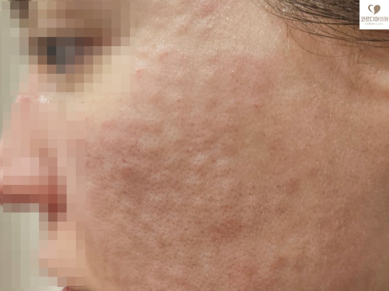 리쥬란을 맞아도 효과가 없는 것처럼 느껴지는 이유 6가지｜피부결·탄력·잔주름의 차이 | 선릉역 피부과 사진 5
