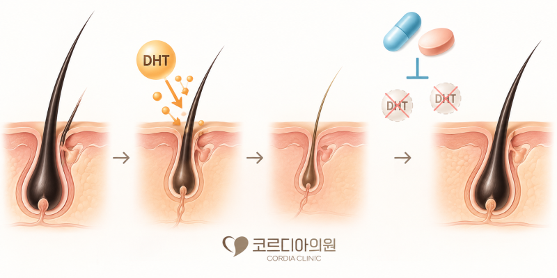 선릉역 탈모약은 평생 먹어야 하나요? 약을 끊으면 다시 머리카락이 빠질까요?