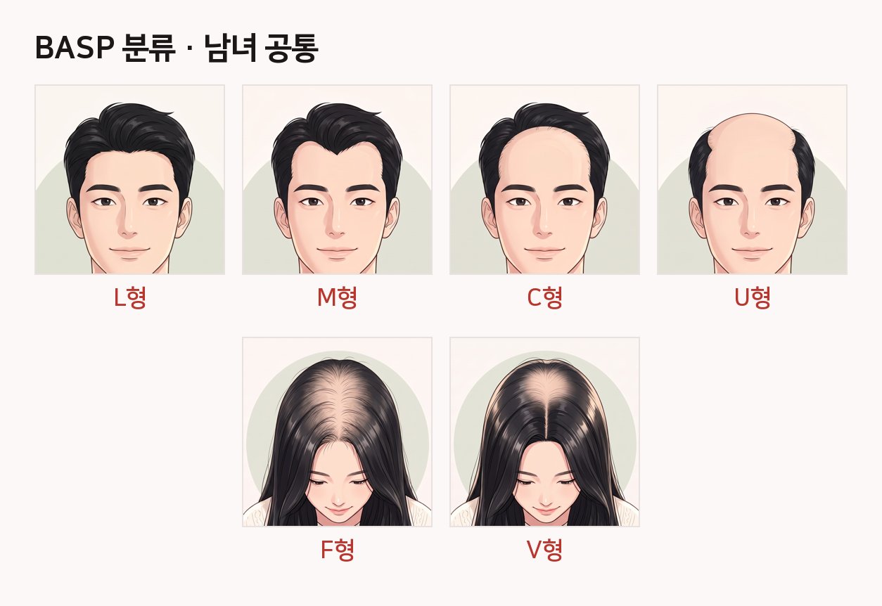 선릉역 탈모 자가진단: 지금 내 탈모는 어느 단계일까? 사진 5