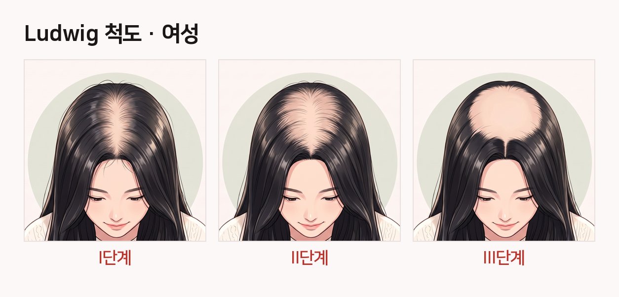 선릉역 탈모 자가진단: 지금 내 탈모는 어느 단계일까?