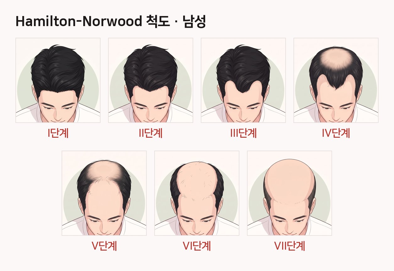 선릉역 탈모 자가진단: 지금 내 탈모는 어느 단계일까? 사진 3