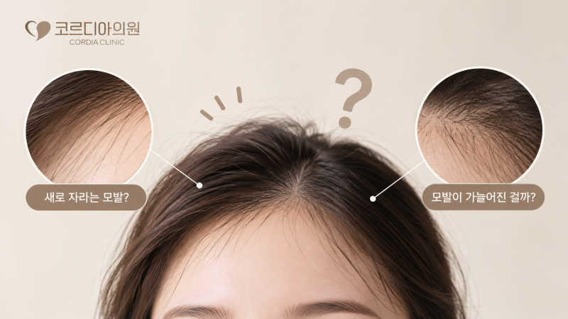 잔머리가 많아진 건 새 머리가 나는 걸까, 모발이 가늘어진 걸까? 선릉역 탈모병원