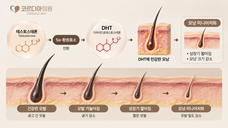 운동하면 탈모가 생긴다? 남성호르몬과 DHT에 대한 오해 | 역삼동 탈모병원